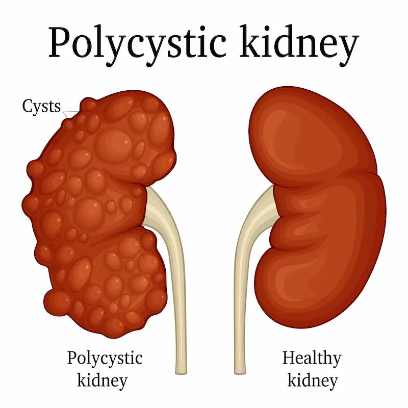 Gym Supplements and Kidney Damage; A Complete Safety Guide